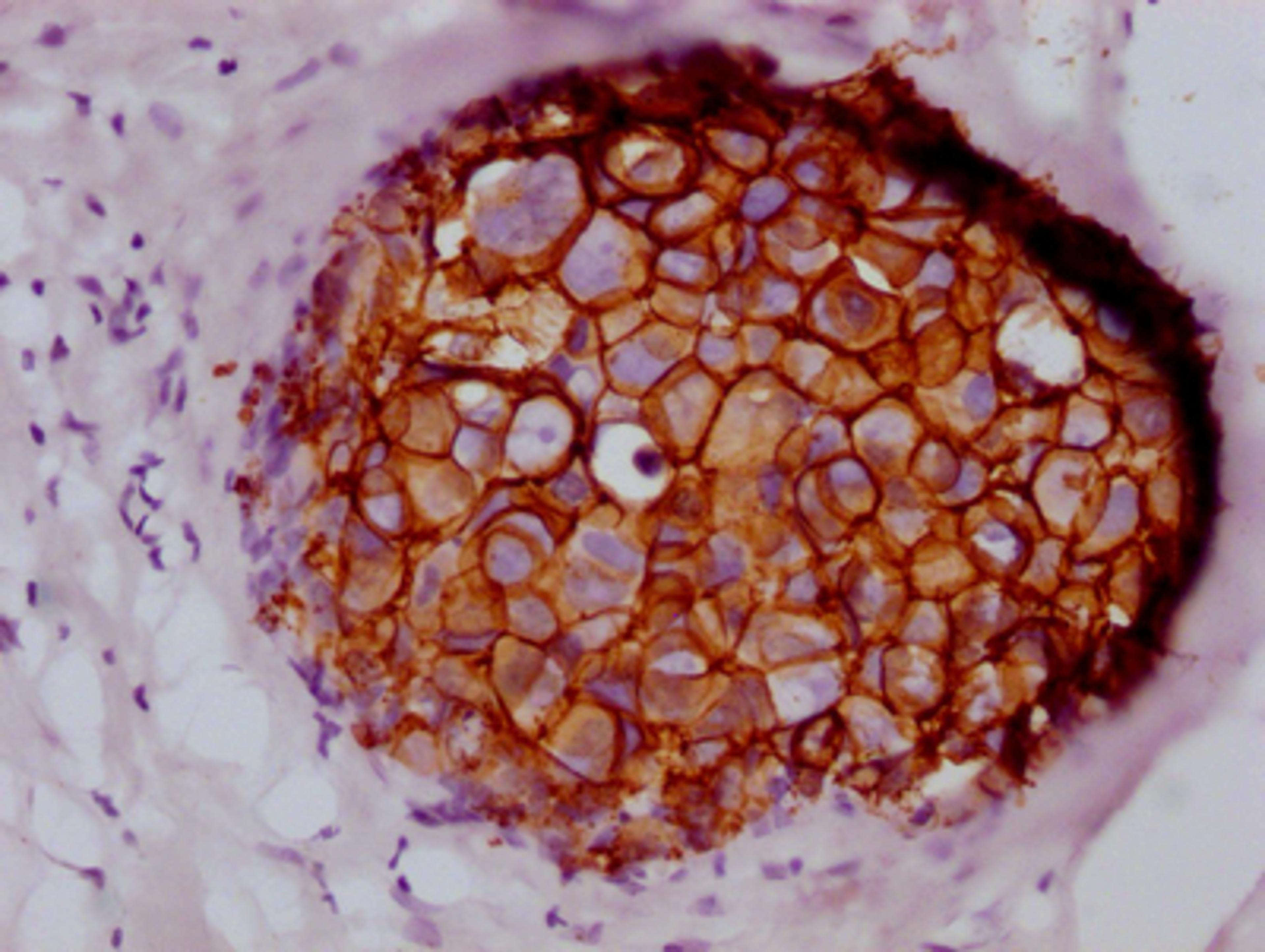 IHC image of CSB-RA260392A0HU diluted at 1:100 and staining in paraffin-embedded human breast cancer performed on a Leica BondTM system. After dewaxing and hydration, antigen retrieval was mediated by high pressure in a citrate buffer (pH 6.0). Section was blocked with 10% normal goat serum 30min at RT. Then primary antibody (1% BSA) was incubated at 4℃ overnight. The primary is detected by a Goat anti-rabbit IgG polymer labeled by HRP and visualized using 0.05% DAB.