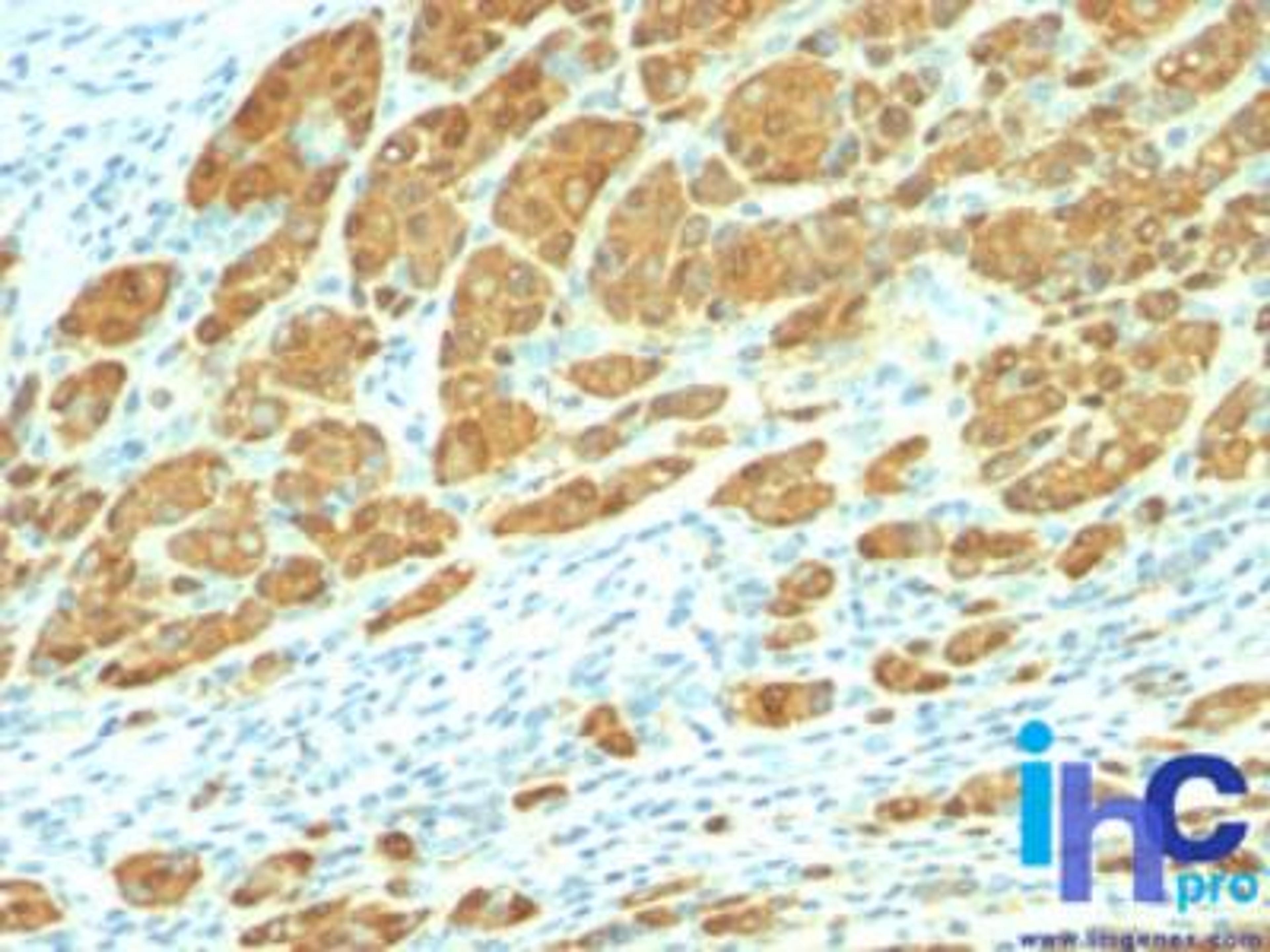 Immunohistochemistry-Paraffin: S100A1 Antibody (4C4.9) [NBP2-29403] - Formalin-fixed, paraffin-embedded human melanoma stained with S100 4C4.9 antibody at 1:200 using peroxidase-conjugate and DAB chromogen. Note cytoplasmic staining.