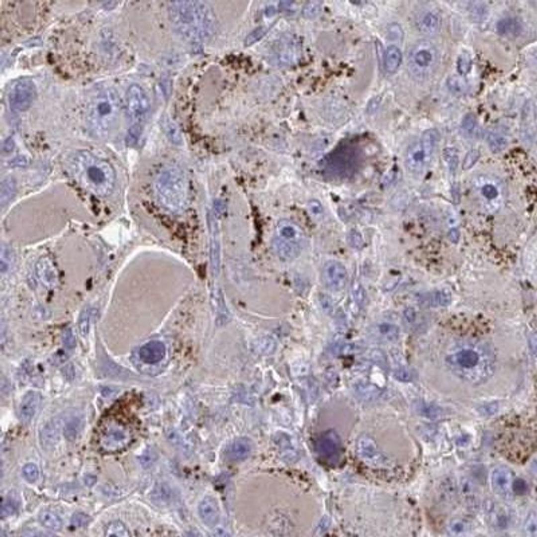 Immunohistochemistry: NGL-3/LRRC4B/LRCH4B Antibody [NBP2-31736] - Liver cancer