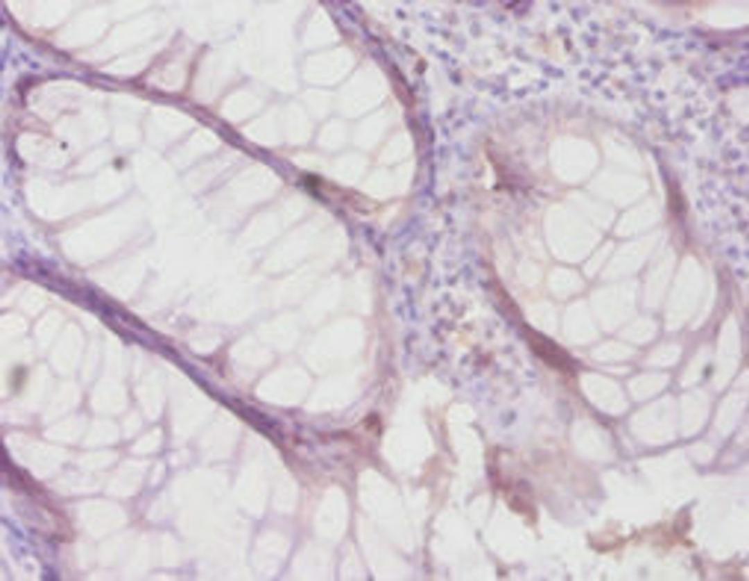 Immunohistochemistry of paraffin-embedded human colon cancer using CSB-PA07419A0Rb at dilution of 1:100