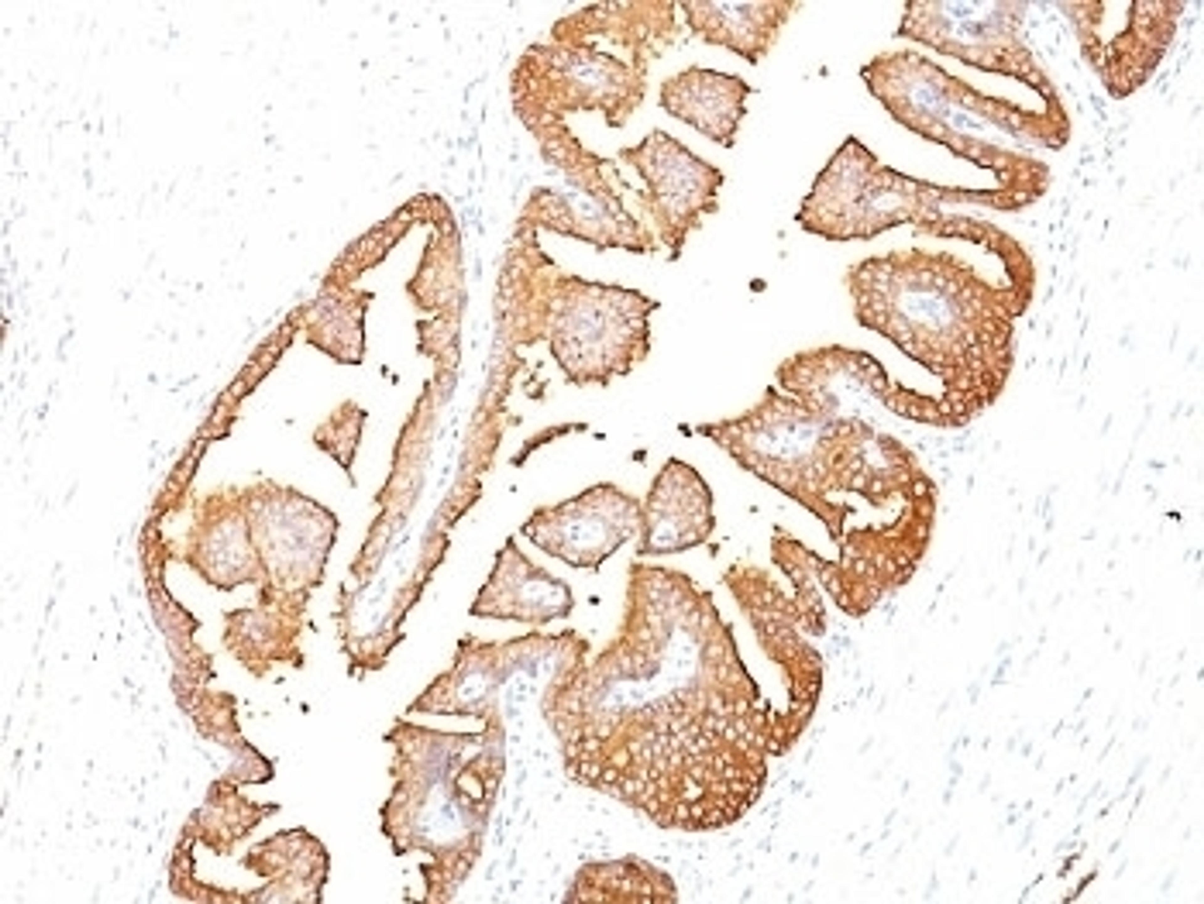 PSA antibody IHC testing of formalin-paraffin human prostate carcinoma.