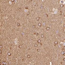 Immunohistochemistry-Paraffin: IL10RB Antibody [NBP2-33492] - glioma