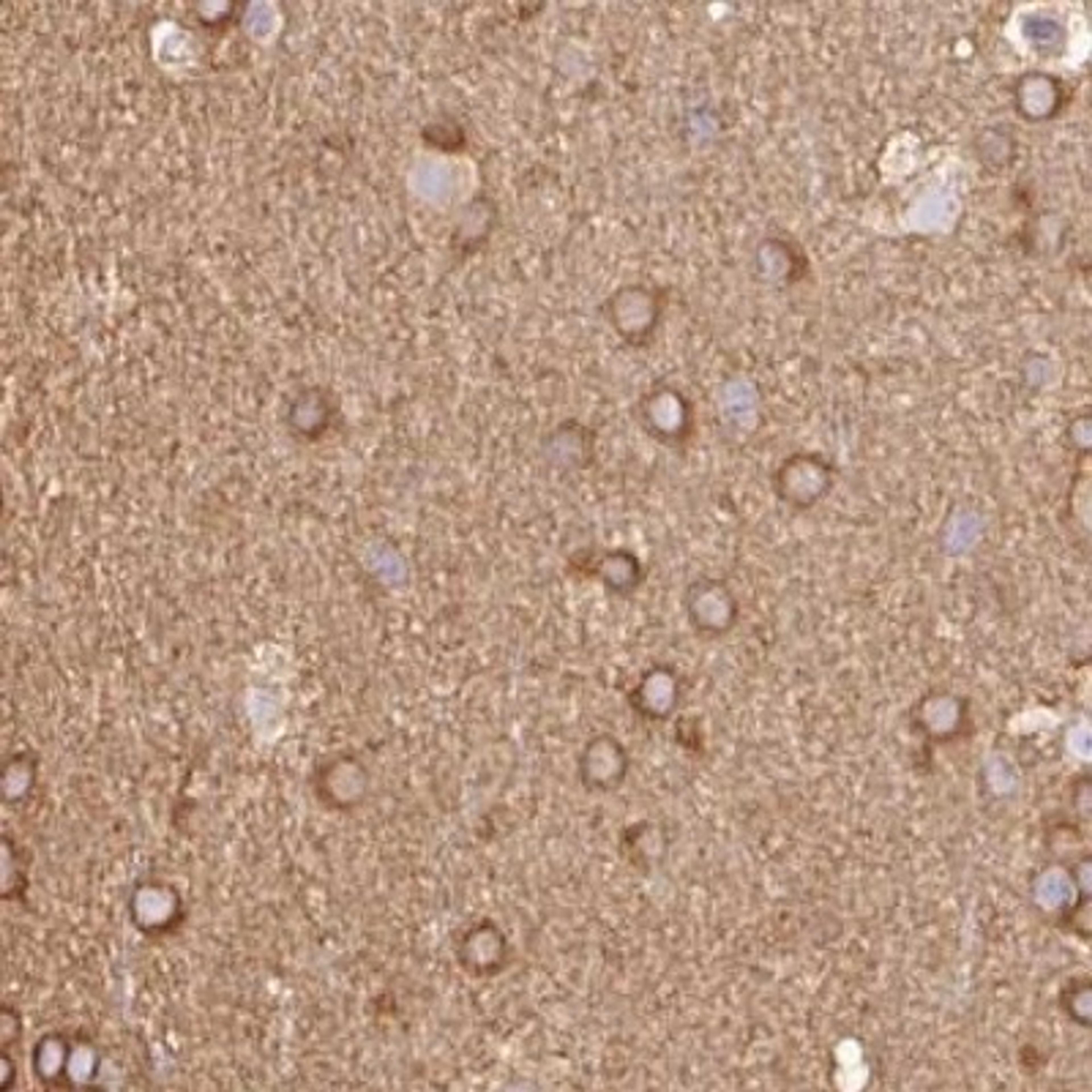 Immunohistochemistry-Paraffin: IL10RB Antibody [NBP2-33492] - glioma