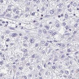 Immunohistochemistry: TMEM150B Antibody [NBP2-32532] - liver cancer