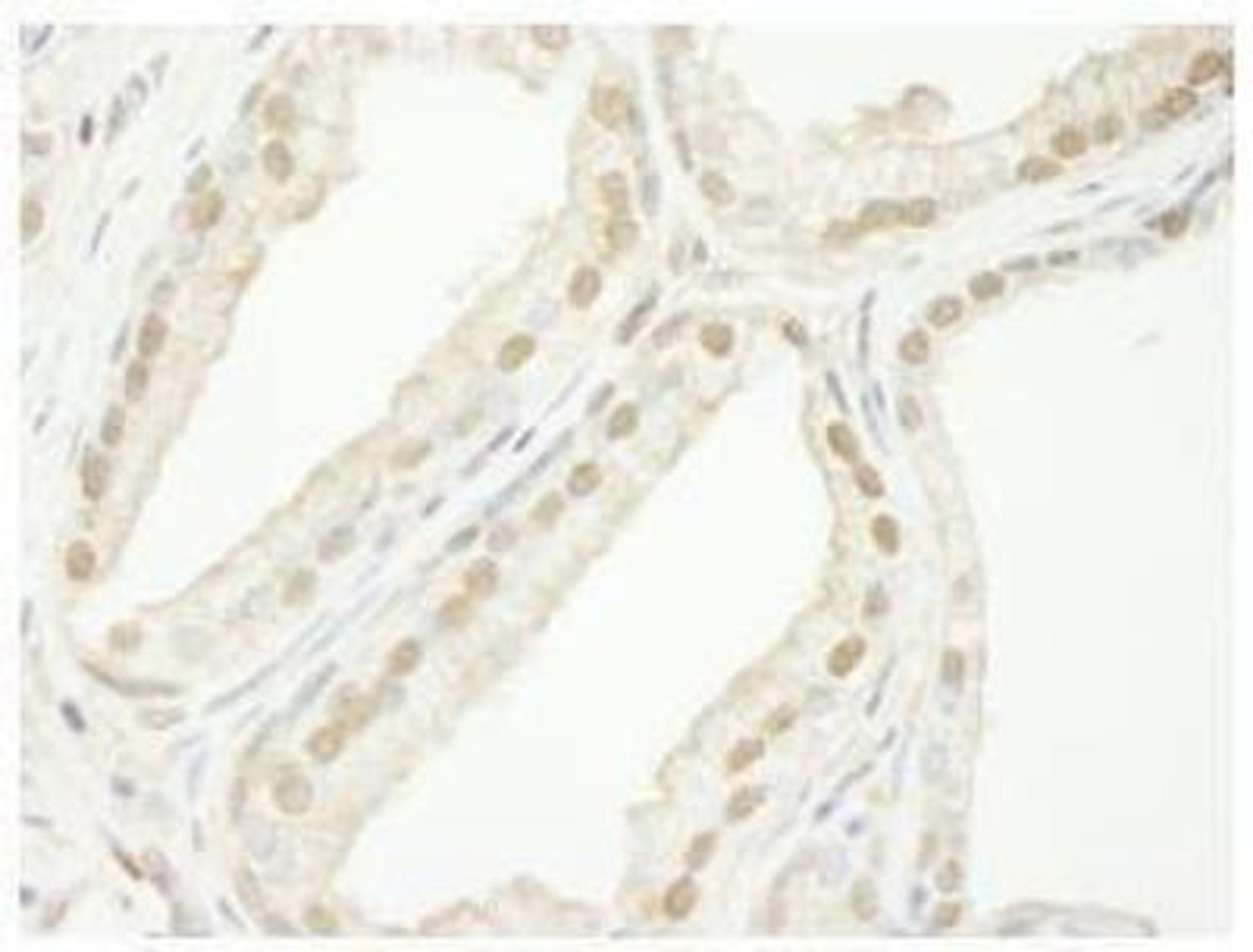 Immunohistochemistry-Paraffin: TIF1 gamma Antibody [NB100-57498] - FFPE section of human  prostate adenocarcinoma.   Affinity purified rabbit anti-TIF1gamma used at a dilution of 1:250. Detection: DAB staining using Immunohistochemistry Accessory Kit