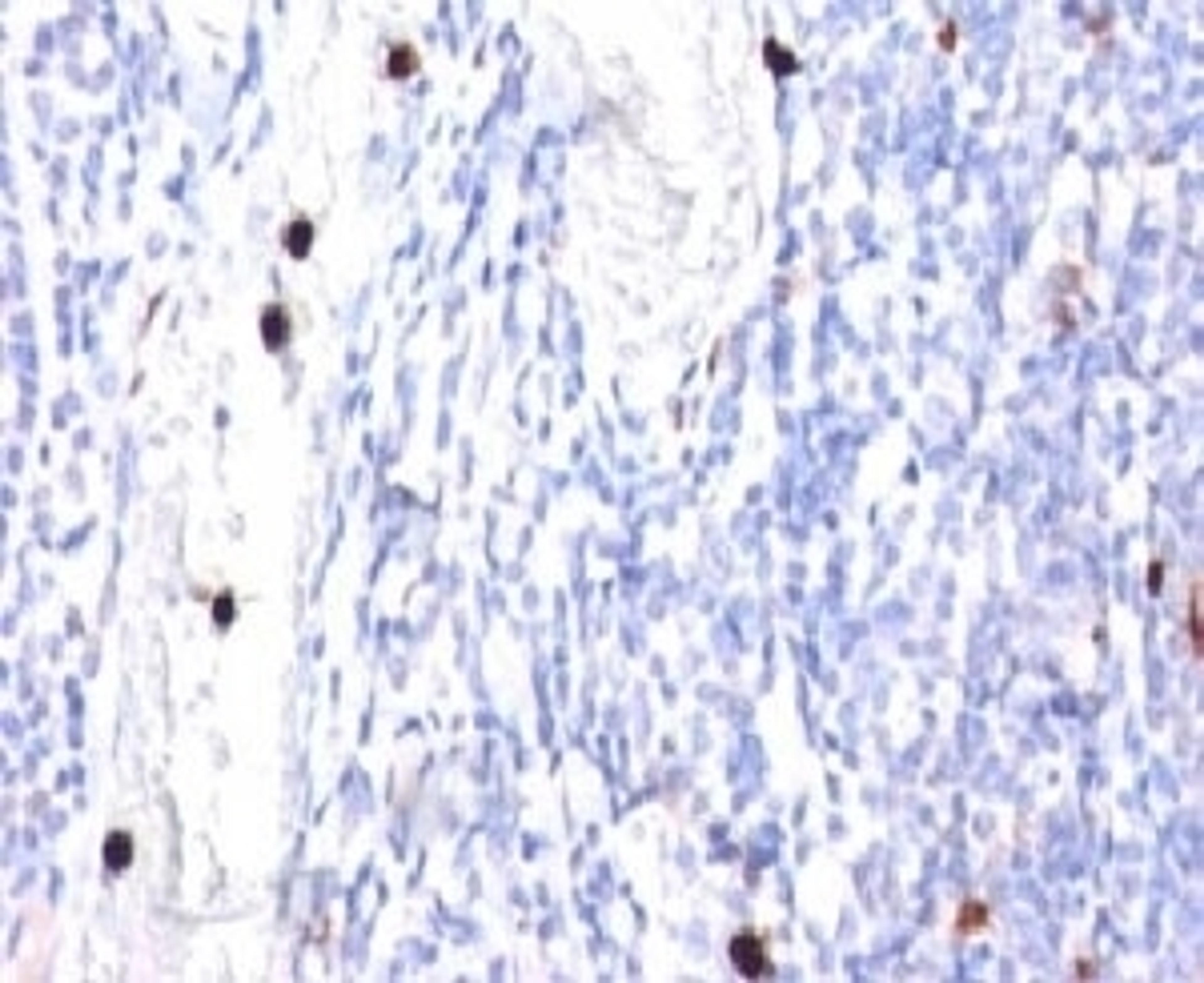 Formalin-fixed, paraffin-embedded human tonsil stained with G-CSF antibody (CSF3/900). Note specific cytoplasmic staining of granulocytes.