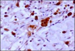 Immunohistochemistry-Paraffin: EGLN3/PHD3 Antibody [NB100-139] - IHC-P analysis of a formalin fixed tissue section of human renal cell carcinoma (clear cell type) using rabbit polyclonal EGLN3/PHD3 antibody with HRP-DAB detection and hematoxylin counterstaining. The antibody generated a strong nuclear staining of PHD3 primarily in the cancer cells while the stromal cells were largely negative for this protein.