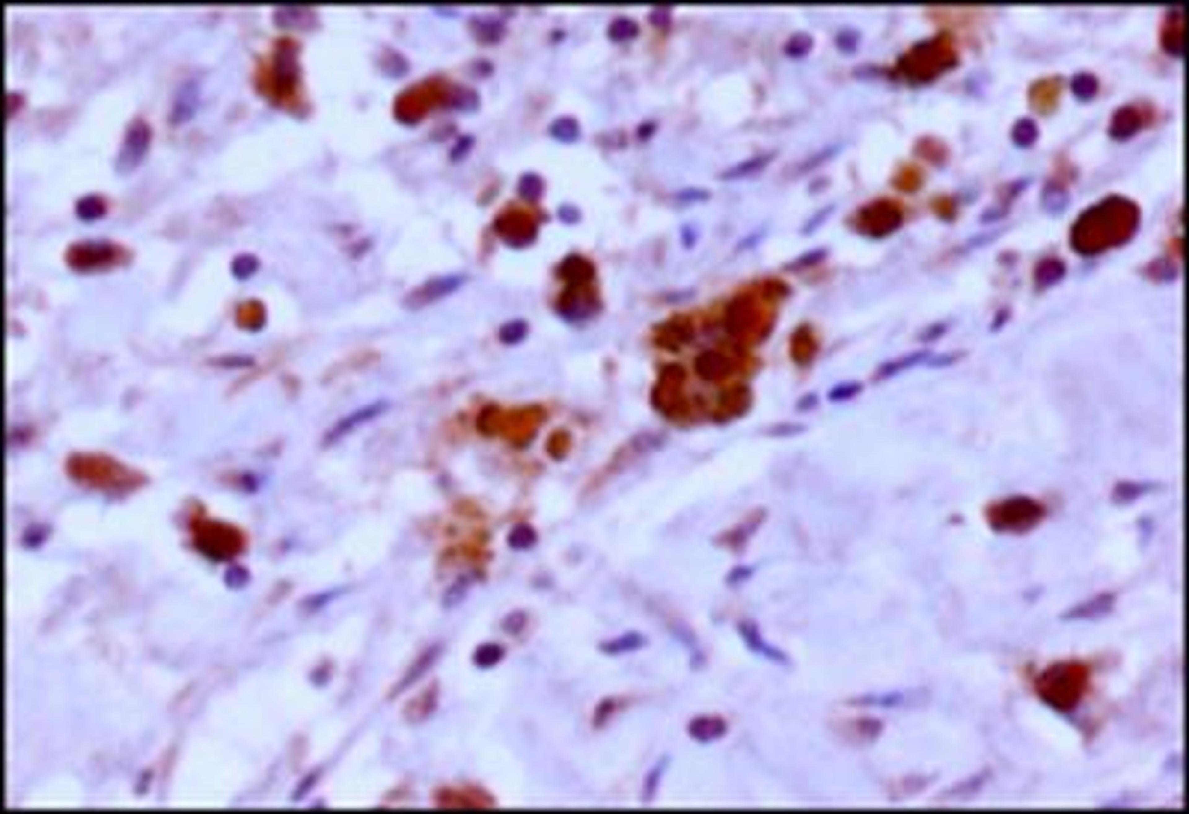 Immunohistochemistry-Paraffin: EGLN3/PHD3 Antibody [NB100-139] - IHC-P analysis of a formalin fixed tissue section of human renal cell carcinoma (clear cell type) using rabbit polyclonal EGLN3/PHD3 antibody with HRP-DAB detection and hematoxylin counterstaining. The antibody generated a strong nuclear staining of PHD3 primarily in the cancer cells while the stromal cells were largely negative for this protein.