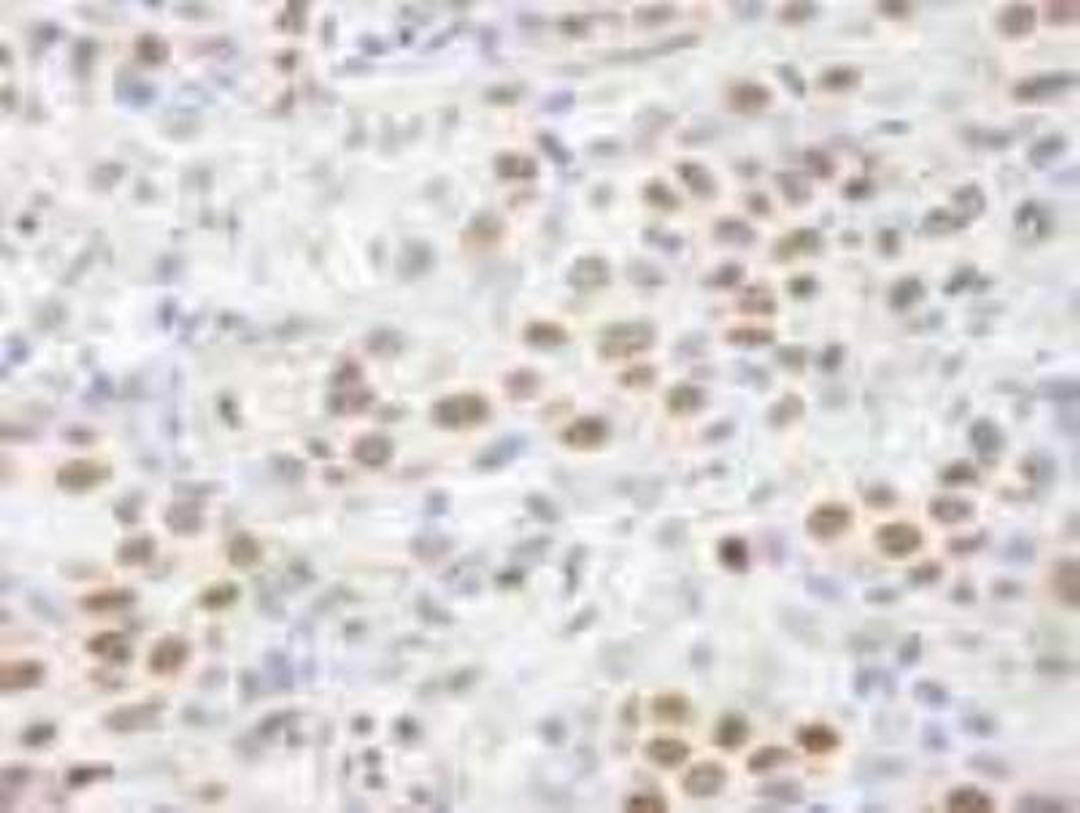 Immunohistochemistry-Paraffin: CHD8 Antibody [NB100-60418] - FFPE section of human breast carcinoma.   Affinity purified rabbit anti-CHD8 used at a dilution of 1:100.