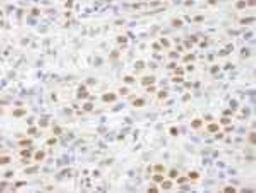 Immunohistochemistry-Paraffin: CHD8 Antibody [NB100-60418] - FFPE section of human breast carcinoma.   Affinity purified rabbit anti-CHD8 used at a dilution of 1:100.