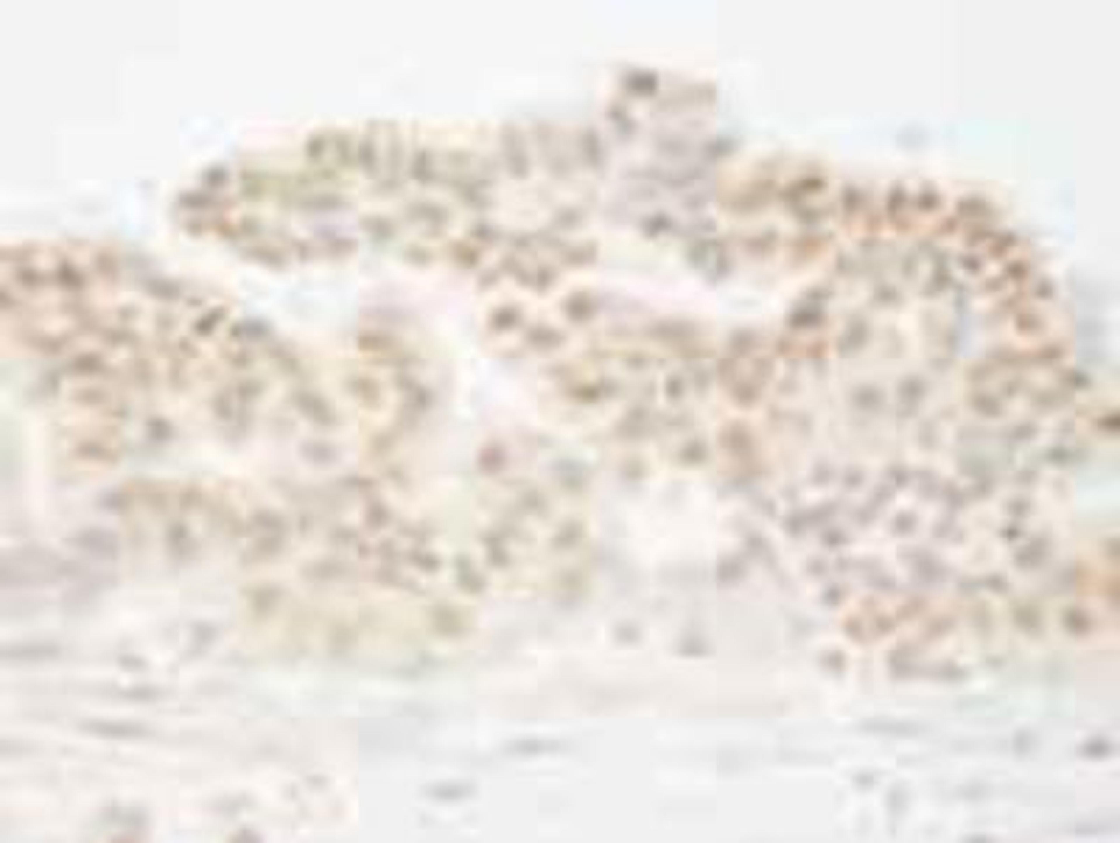 Immunohistochemistry-Paraffin: cleavage stimulation factor Antibody [NB100-60443] - FFPE section of human ovarian carcinoma.  NB100-60443 used at a dilution of 1:250.