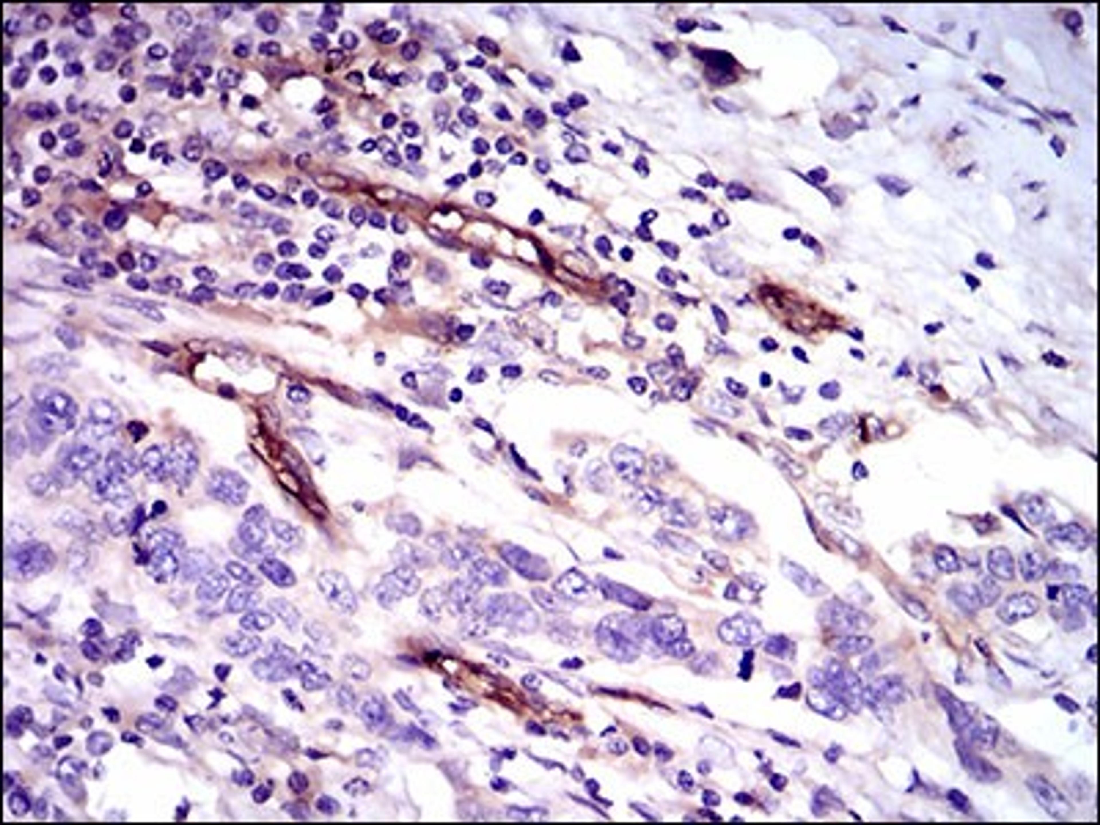 Immunohistochemistry: CD59 Antibody (8D2B8) [NBP2-37436] - Immunohistochemical analysis of paraffin-embedded esophageal cancer tissues using CD59 mouse mAb with DAB staining.