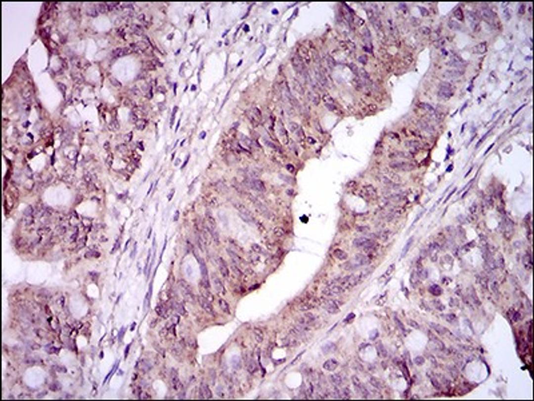 Immunohistochemistry: Integrin alpha 2b/CD41 Antibody (2E10C9) [NBP2-37384] - Immunohistochemical analysis of paraffin-embedded rectum cancer tissues using ITGA2B mouse mAb with DAB staining.