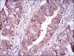 Immunohistochemistry: Integrin alpha 2b/CD41 Antibody (2E10C9) [NBP2-37384] - Immunohistochemical analysis of paraffin-embedded rectum cancer tissues using ITGA2B mouse mAb with DAB staining.