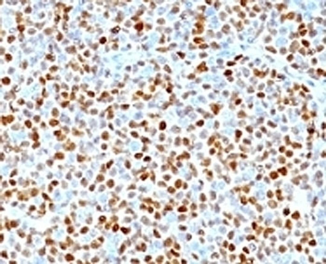 Formalin-fixed, paraffin-embedded human mantle cell lymphoma stained with CCND1 antibody.