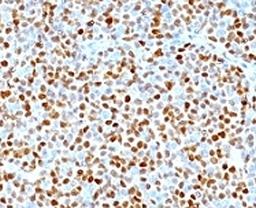 Formalin-fixed, paraffin-embedded human mantle cell lymphoma stained with CCND1 antibody.