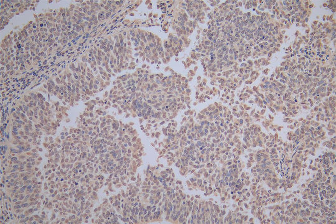 IHC image of CSB-RA010833MA1HU diluted at 1:100 and staining in paraffin-embedded human cervical cancer performed on a Leica BondTM system. After dewaxing and hydration,  antigen retrieval was mediated by high pressure in a citrate buffer (pH 6.0). Section was blocked with 10% normal goat serum 30min at RT. Then primary antibody (1% BSA) was incubated at 4°C overnight. The primary is detected by a Goat anti-Mouse IgG labeled by HRP and visualized using 0.05% DAB.
