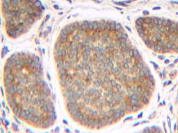 This antibody stained formalin-fixed paraffin-embedded sections of human carcinoid tissue. The recommended concentration is 0.25 ug/ml with an overnight incubation at 4&#730;C. An HRP-labeled polymer detection system was used with a DAB chromogen. Heat in