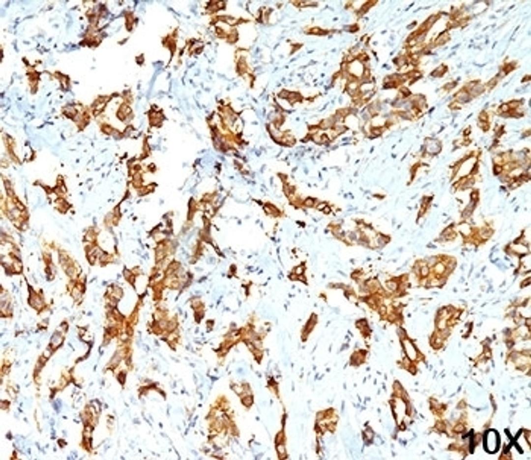 IHC testing of human breast carcinoma (10X) stained with HSP27 antibody (G3.1).