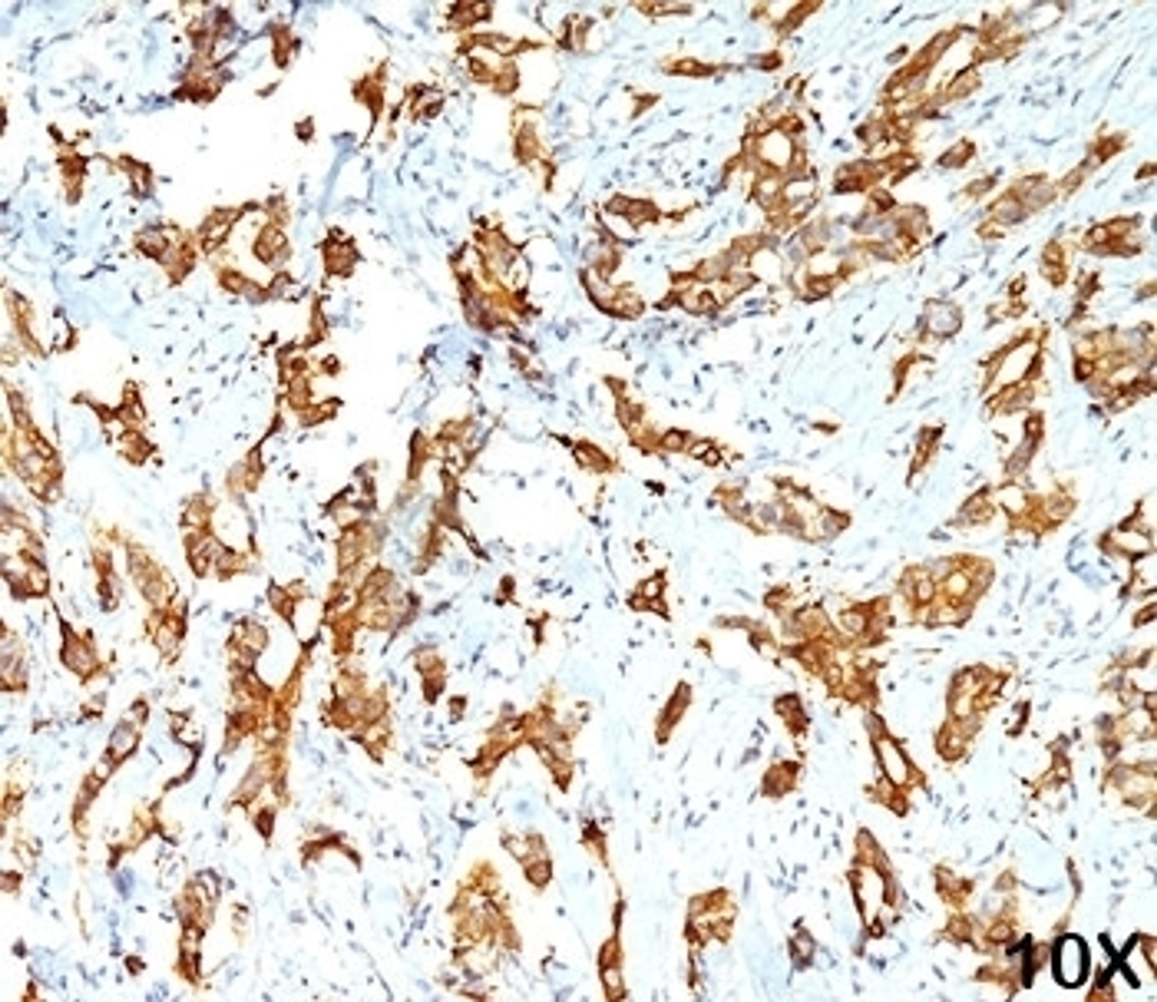 IHC testing of human breast carcinoma (10X) stained with HSP27 antibody (G3.1).