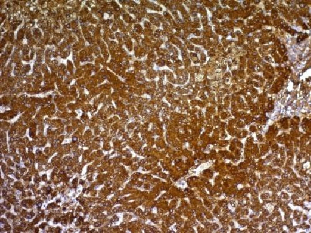 Immunohistochemical staining of human Hepatocellular carcinoma tissue using HepPar-1 antibody