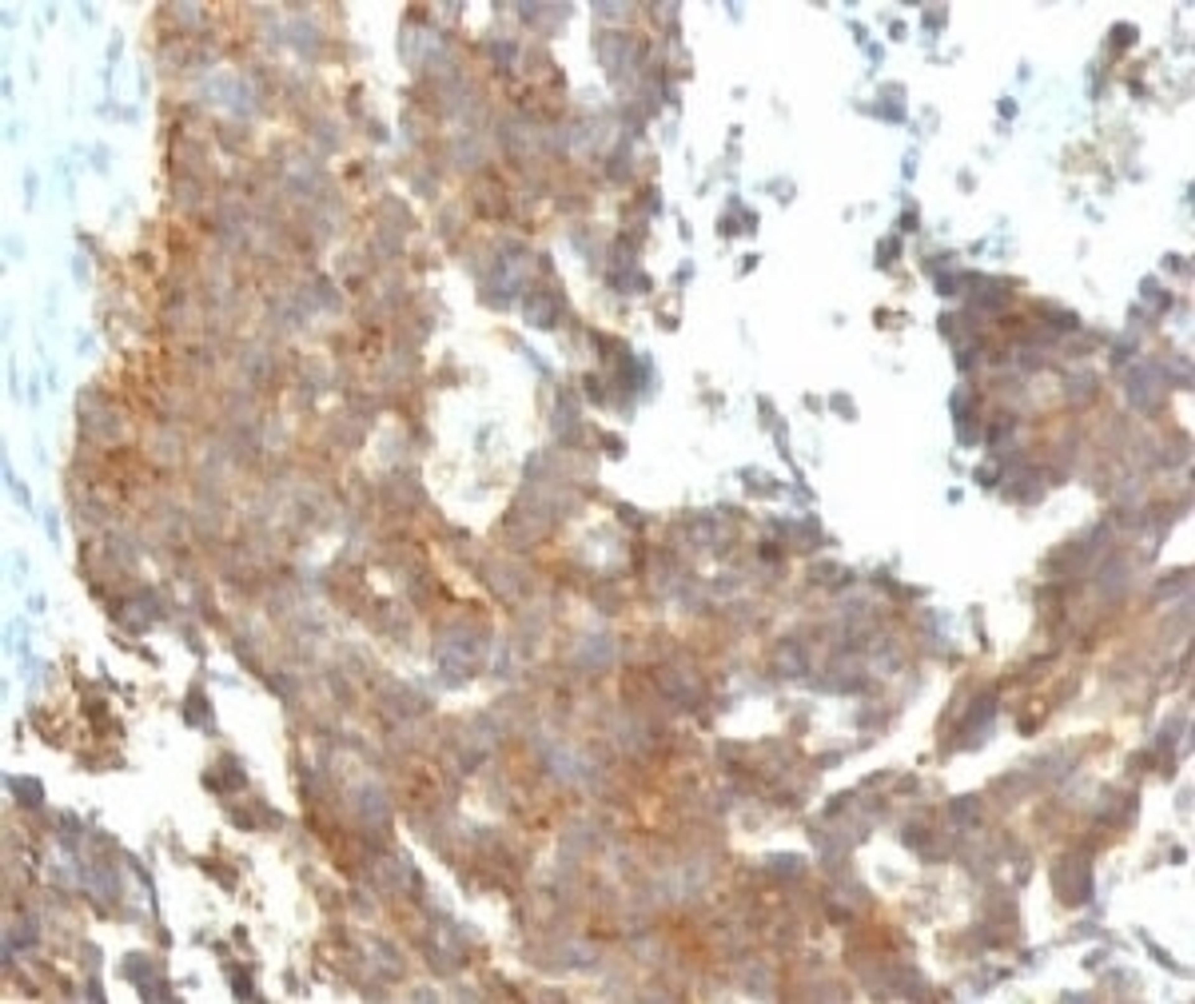 Formalin-fixed, paraffin-embedded human ovarian carcinoma stained with GnRH Receptor antibody (GNRHR/768)