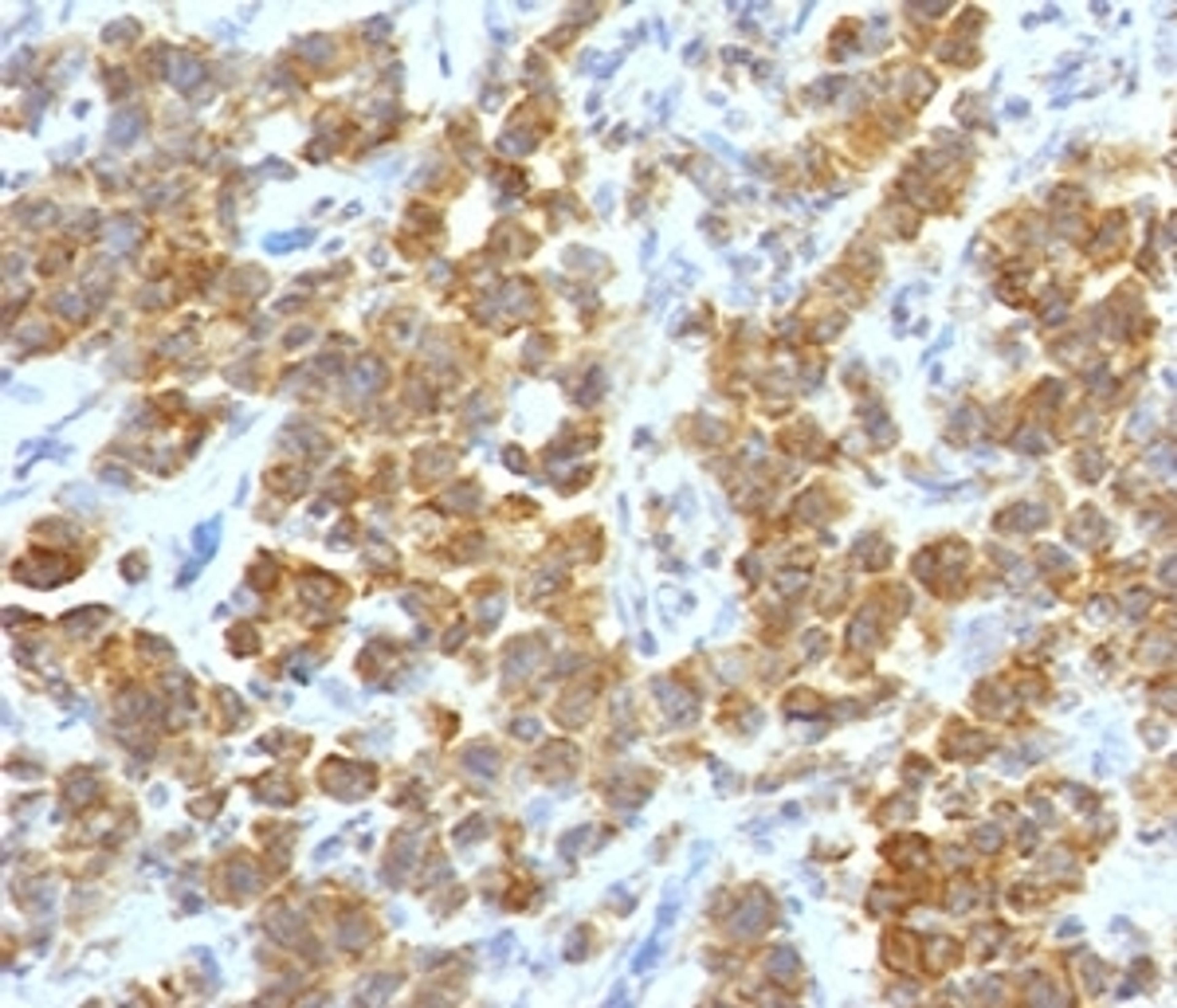 IHC testing of FFPE human parathyroid tumor with TL1A antibody (clone TLRM1-1).