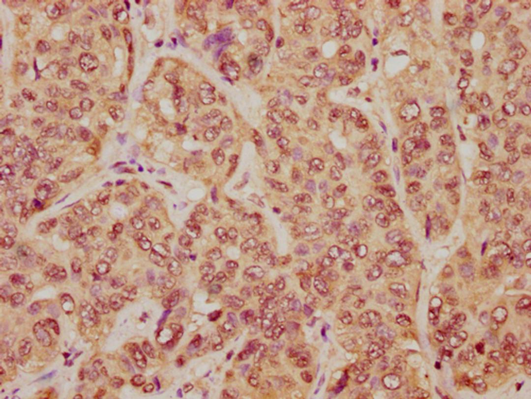 IHC image of CSB-PA010403PA23nme1HU diluted at 1:20 and staining in paraffin-embedded human liver cancer performed on a Leica BondTM system. After dewaxing and hydration, antigen retrieval was mediated by high pressure in a citrate buffer (pH 6.0). Section was blocked with 10% normal goat serum 30min at RT. Then primary antibody (1% BSA) was incubated at 4°C overnight. The primary is detected by a biotinylated secondary antibody and visualized using an HRP conjugated SP system.