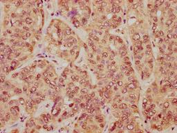 IHC image of CSB-PA010403PA23nme1HU diluted at 1:20 and staining in paraffin-embedded human liver cancer performed on a Leica BondTM system. After dewaxing and hydration, antigen retrieval was mediated by high pressure in a citrate buffer (pH 6.0). Section was blocked with 10% normal goat serum 30min at RT. Then primary antibody (1% BSA) was incubated at 4°C overnight. The primary is detected by a biotinylated secondary antibody and visualized using an HRP conjugated SP system.