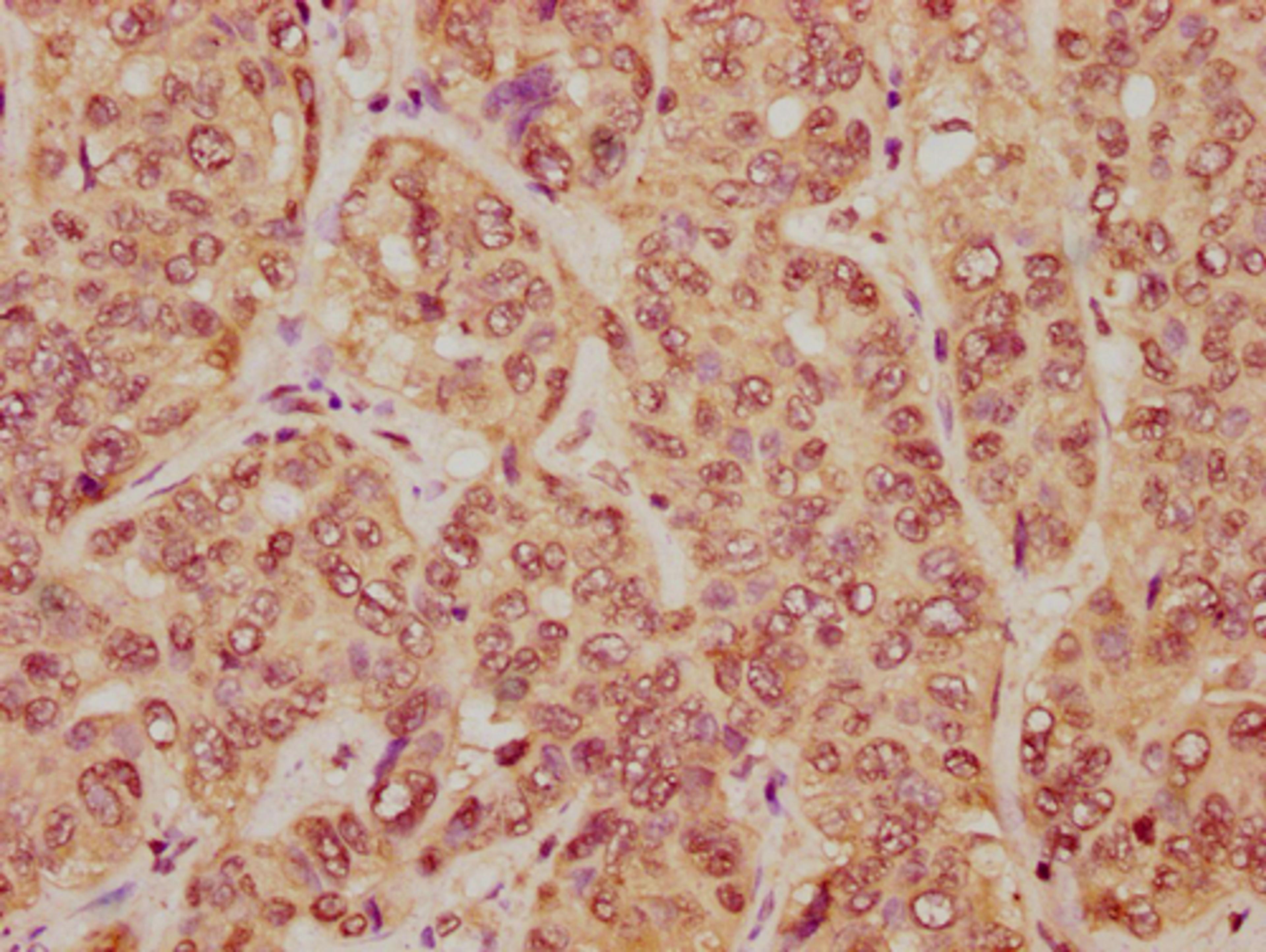 IHC image of CSB-PA010403PA23nme1HU diluted at 1:20 and staining in paraffin-embedded human liver cancer performed on a Leica BondTM system. After dewaxing and hydration, antigen retrieval was mediated by high pressure in a citrate buffer (pH 6.0). Section was blocked with 10% normal goat serum 30min at RT. Then primary antibody (1% BSA) was incubated at 4°C overnight. The primary is detected by a biotinylated secondary antibody and visualized using an HRP conjugated SP system.