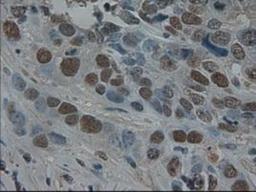 Immunohistochemistry-Paraffin: Pancreatic Amylase Alpha Antibody (6D4) [NBP1-47659] - Pancreatic Amylase Alpha Antibody (6D4) Staining of paraffin-embedded Adenocarcinoma of breast using anti-Pancreatic Amylase mouse monoclonal antibody.