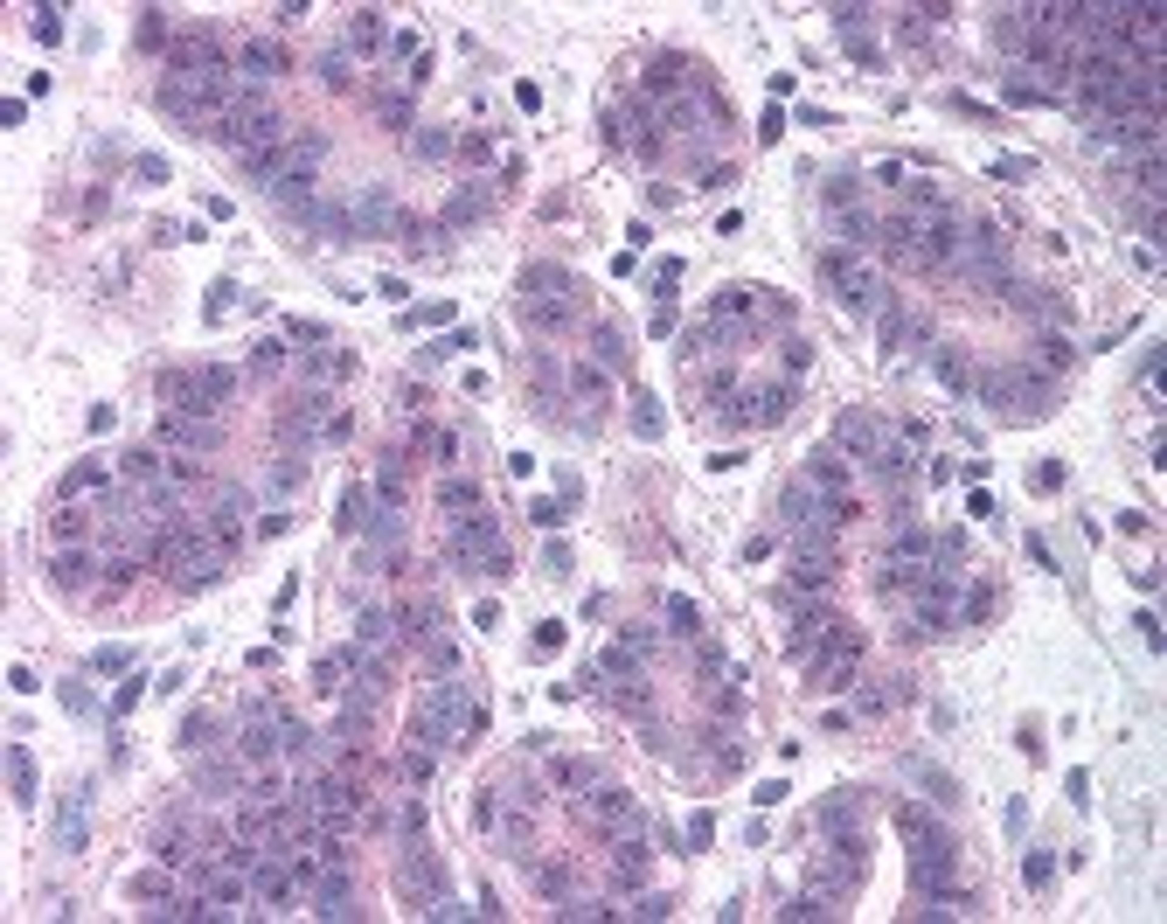 Immunohistochemistry staining of ESR1 in breast tissue using ESR1 Antibody.