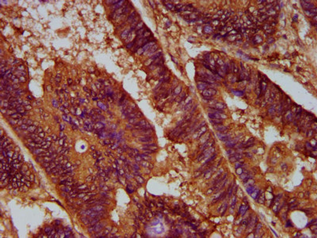 IHC image of CSB-PA872435LA01HU diluted at 1:300 and staining in paraffin-embedded human colon cancer performed on a Leica BondTM system. After dewaxing and hydration, antigen retrieval was mediated by high pressure in a citrate buffer (pH 6.0). Section was blocked with 10% normal goat serum 30min at RT. Then primary antibody (1% BSA) was incubated at 4&deg;C overnight. The primary is detected by a biotinylated secondary antibody and visualized using an HRP conjugated SP system.
