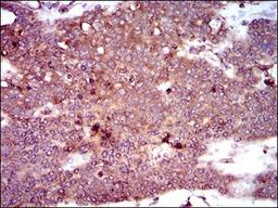 Immunohistochemistry: dynactin 4 Antibody (3G9D7) [NBP2-37399] - Immunohistochemical analysis of paraffin-embedded ovarian cancer tissues using DCTN4 mouse mAb with DAB staining.