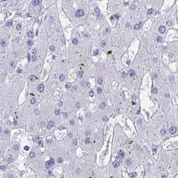 Immunohistochemistry: C19orf81 Antibody [NBP2-32518] - liver cancer