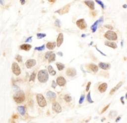 Immunohistochemistry-Paraffin: PNUTS/PPP1R10 Antibody [NB100-604] - Human breast carcinoma. Antibody: Affinity purified rabbit anti-PNUTS used at a dilution of 1:1,000 (1ug/ml). Detection: DAB