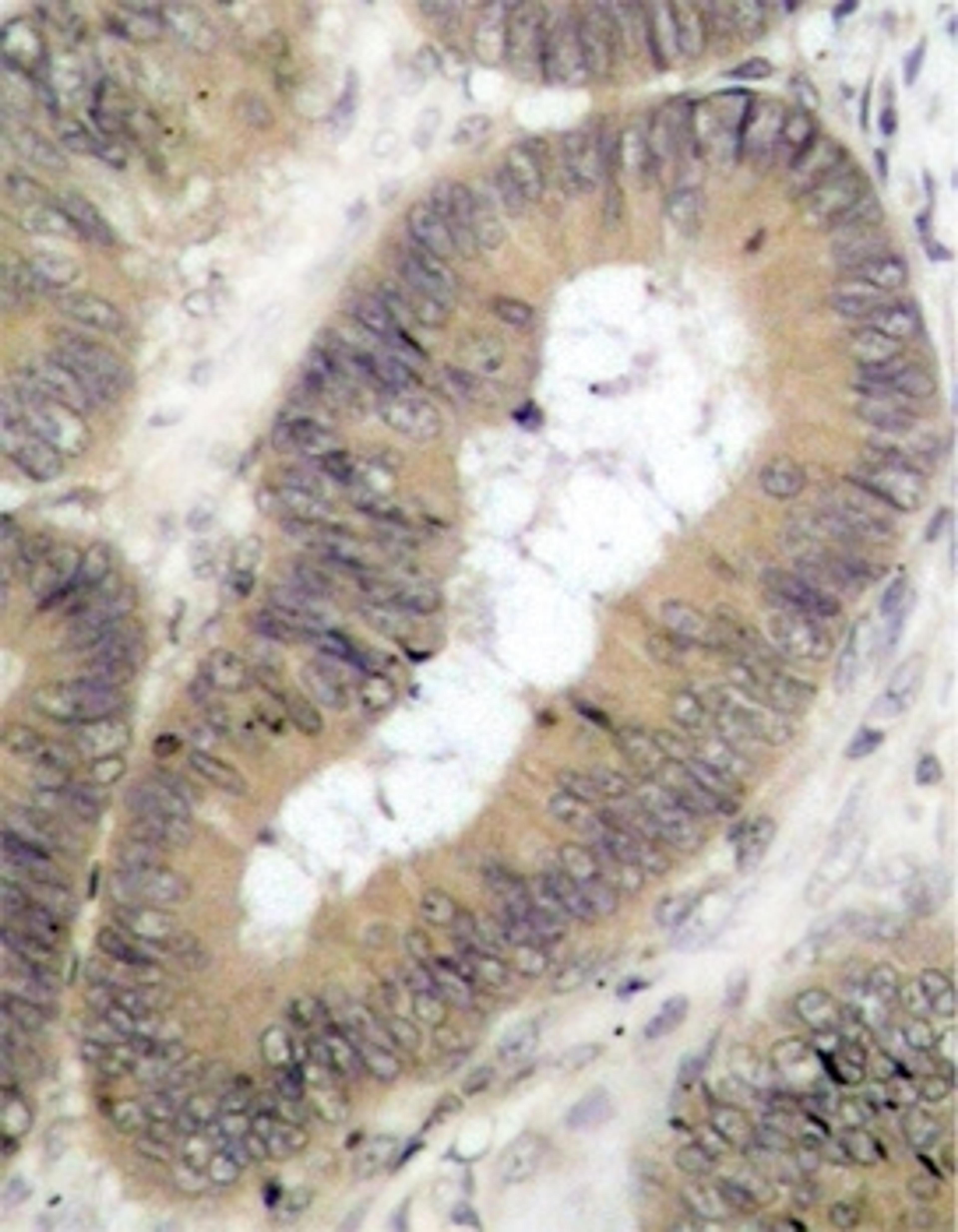 Immunohistochemical analysis of paraffin-embedded human colon carcinoma tissue 