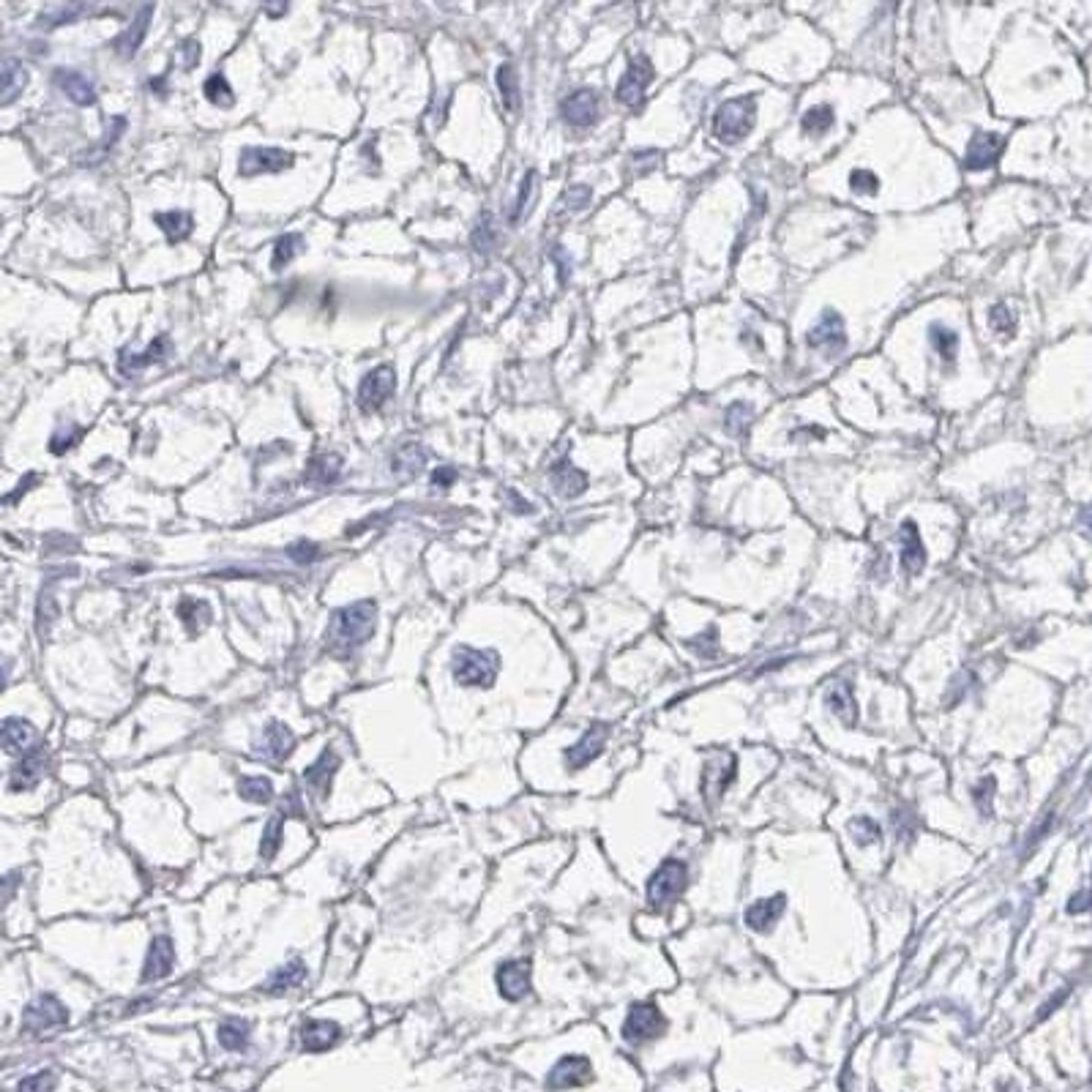 Immunohistochemistry: SPPL3 Antibody [NBP2-32505] - liver cancer