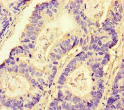 Immunohistochemistry of paraffin-embedded human colon cancer using CSB-PA016092LA01HU at dilution of 1:100