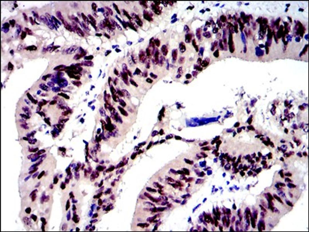 Immunohistochemistry: c-jun Antibody (5B1) [NBP2-37576] - Immunohistochemical analysis of paraffin-embedded human rectum cancer tissues using c-Jun mouse mAb with DAB staining.