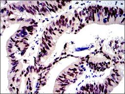 Immunohistochemistry: c-jun Antibody (5B1) [NBP2-37576] - Immunohistochemical analysis of paraffin-embedded human rectum cancer tissues using c-Jun mouse mAb with DAB staining.