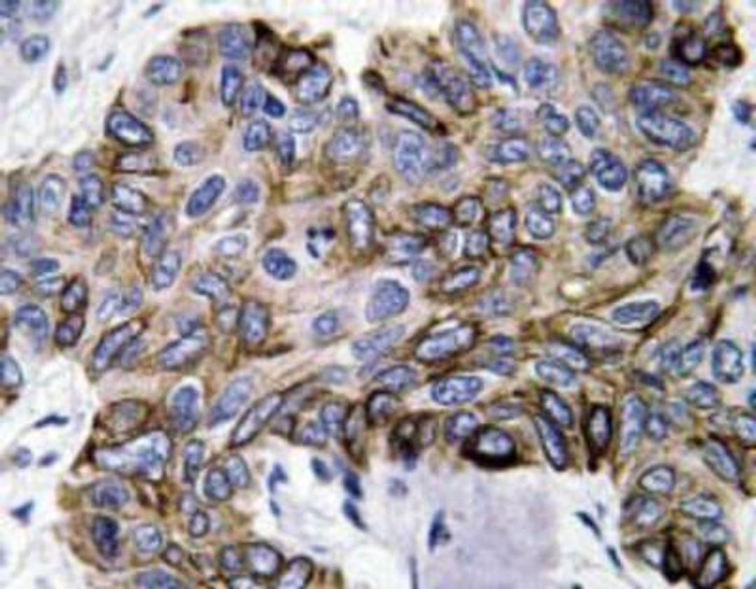 Immunohistochemistry-Paraffin: CCL5/RANTES Antibody [NBP1-19769] - Human lung carcinoma tissue.