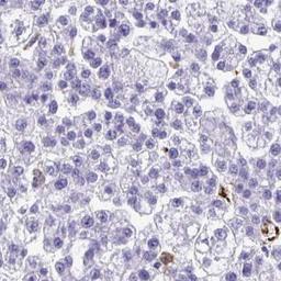 Immunohistochemistry: TP53I11 Antibody [NBP2-32593] - liver cancer