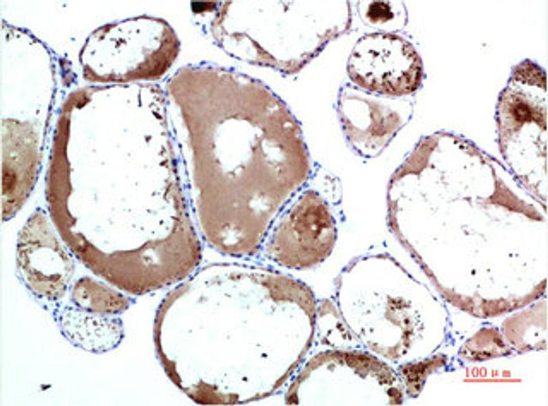 Immunohistochemical analysis of paraffin-embedded Human Thyroid Tissue using TTR Mouse mAb diluted at 1:200.