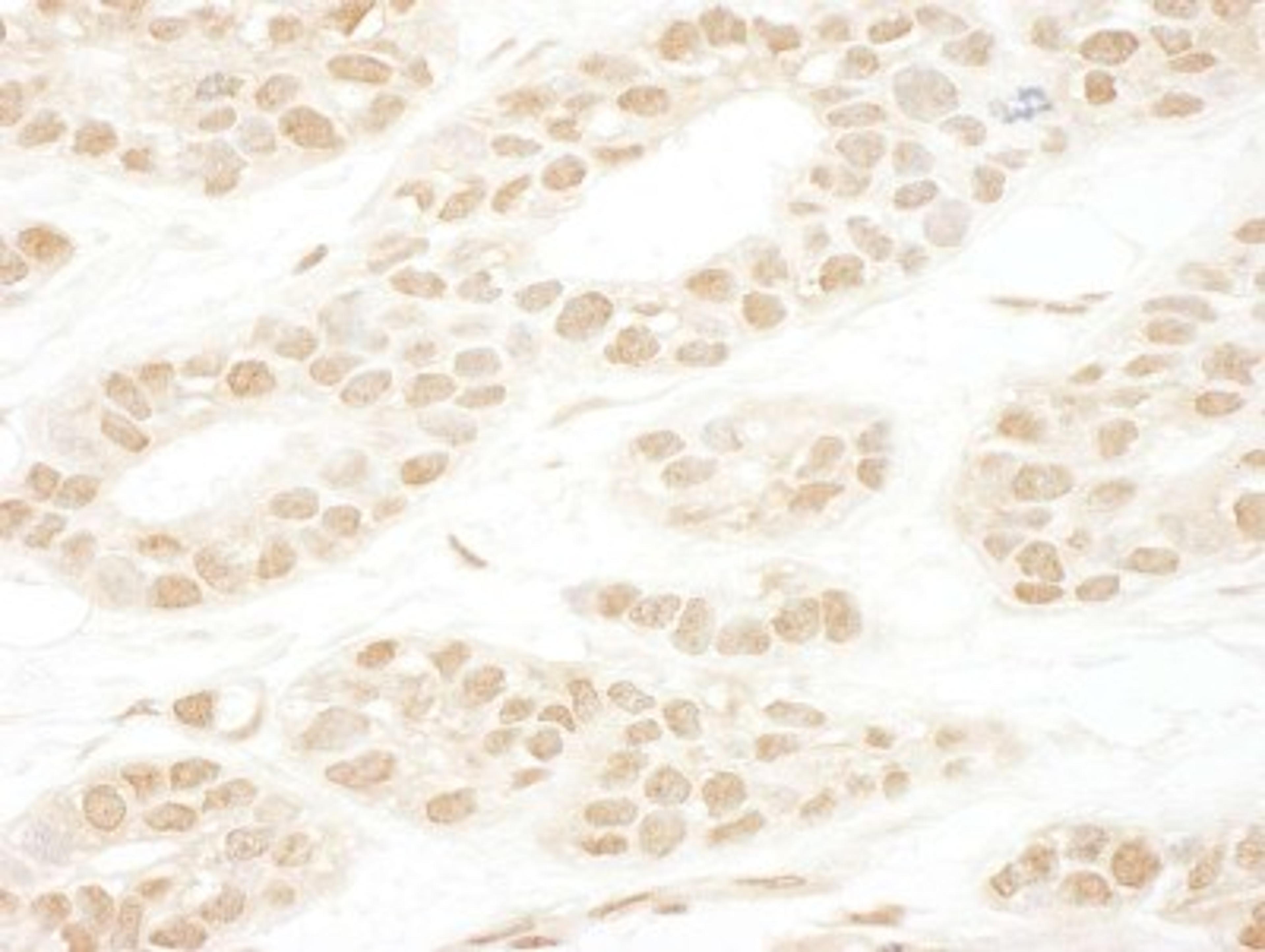 Immunohistochemistry-Paraffin: NCAPH2 Antibody [NBP1-28723] - Human breast carcinoma. Antibody used at a dilution of 1:1000 (1ug/ml).