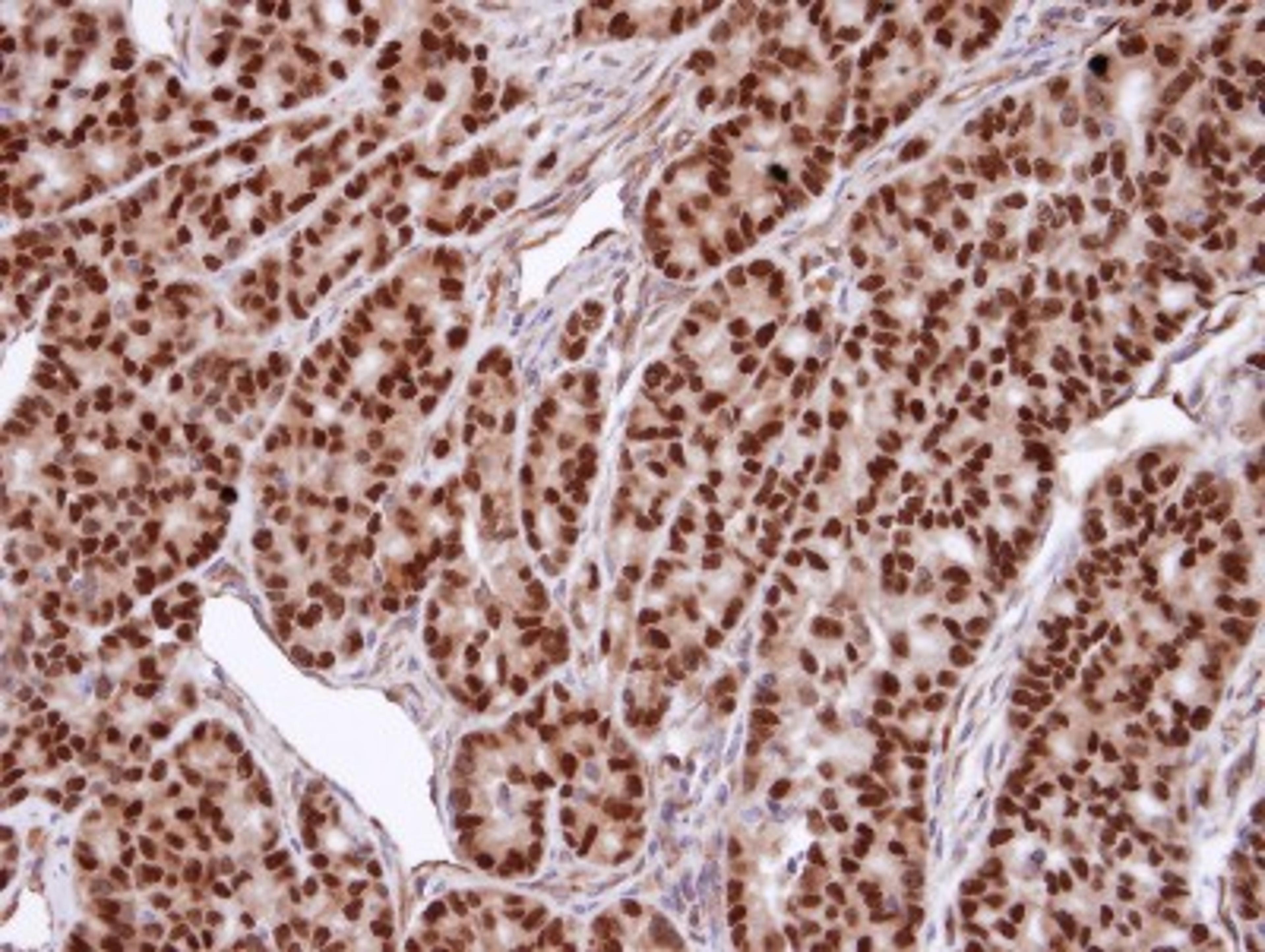 Immunohistochemistry-Paraffin: SNURPORTIN1 Antibody [NBP1-31101] - Paraffin-embedded AGS xenograft, using antibody at 1:100 dilution.