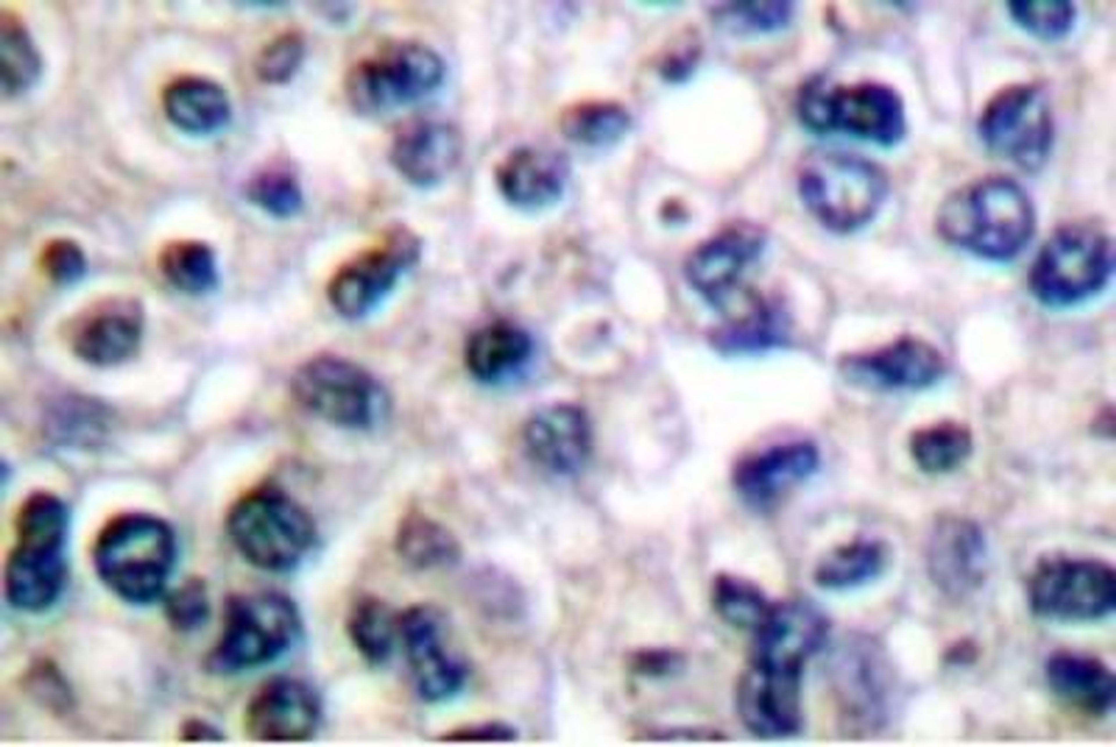 Immunohistochemistry: IGF-I R [p Tyr1161] Antibody [NB100-92555] - Analyzes of p-IGF-1 R  (Y1161) antibody in paraffin-embedded human breast  carcinoma tissue.