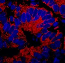 Immunocytochemistry/Immunofluorescence: IP3R3 Antibody [NBP1-21399] - Human stomach carcinoma. Antibody used at a dilution of 1:1000 (1ug/ml).