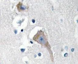 Immunohistochemistry: CaMKII alpha/delta Antibody [NBP1-19721] - Human breast carcinoma tissue.