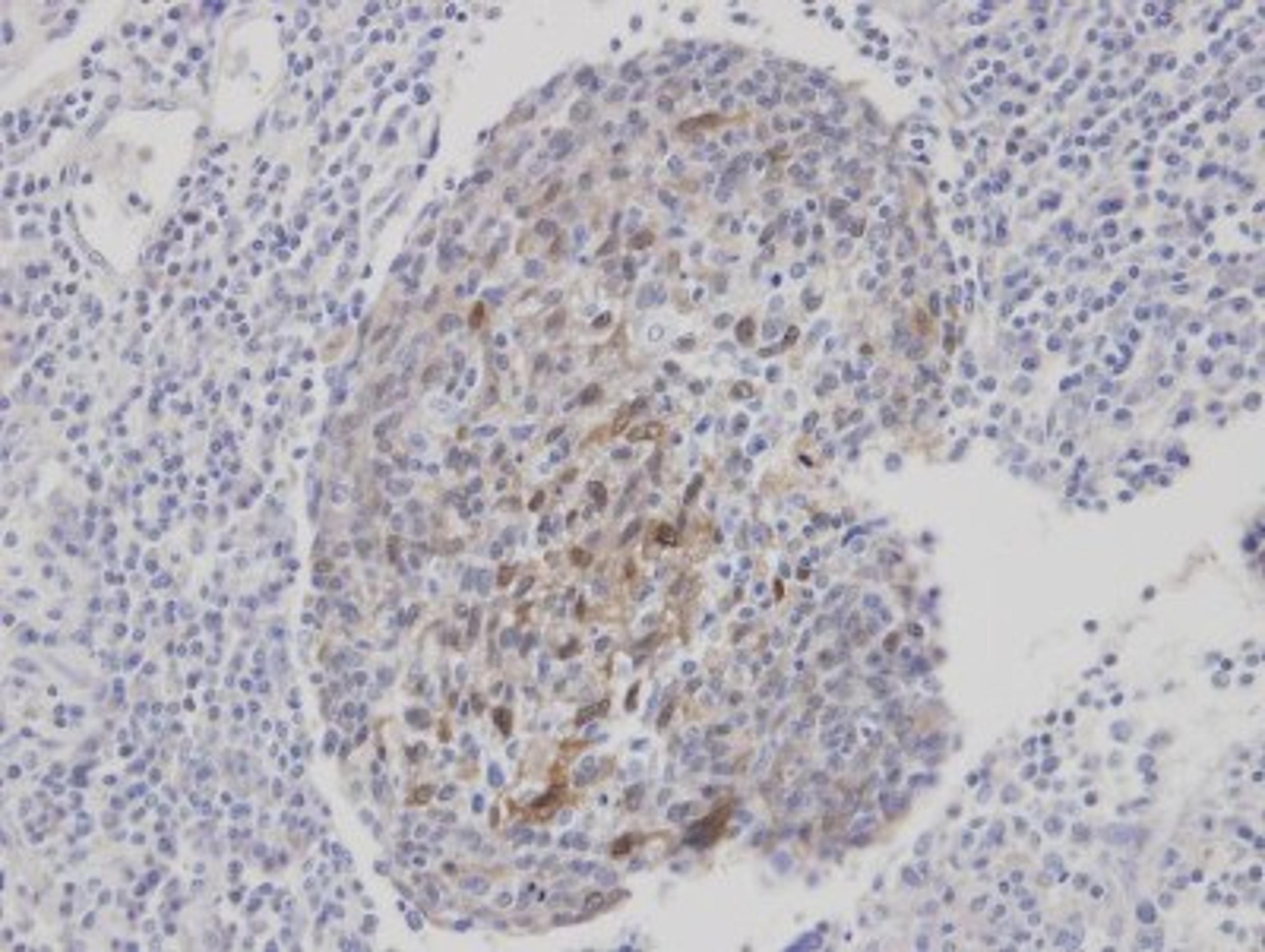 Immunohistochemistry-Paraffin: CLCA1 Antibody [NBP1-31129] - Paraffin-embedded gastric CA, using antibody at 1:100 dilution.